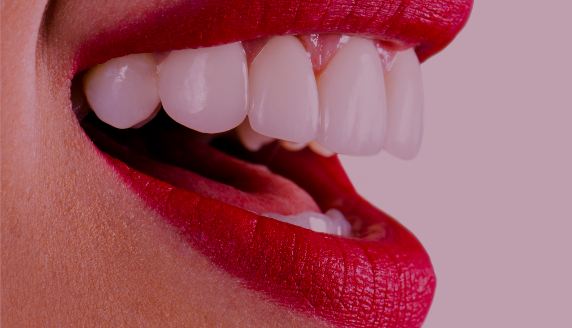 Cómo conseguir dientes más blancos – blanqueamiento
