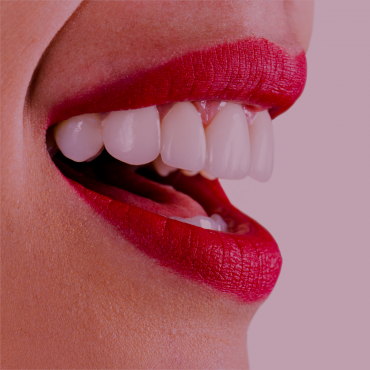 Cómo conseguir dientes más blancos – blanqueamiento