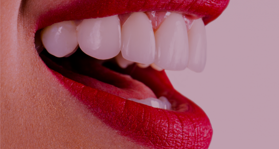 Cómo conseguir dientes más blancos – blanqueamiento