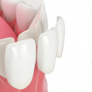 ¿Qué son las carillas dentales o las coronas dentales? ¿Para qué sirven? – estética dental